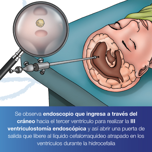 Cirugía Endoscópica De Hidrocefalia Dr Juan Francisco Lasso 0142