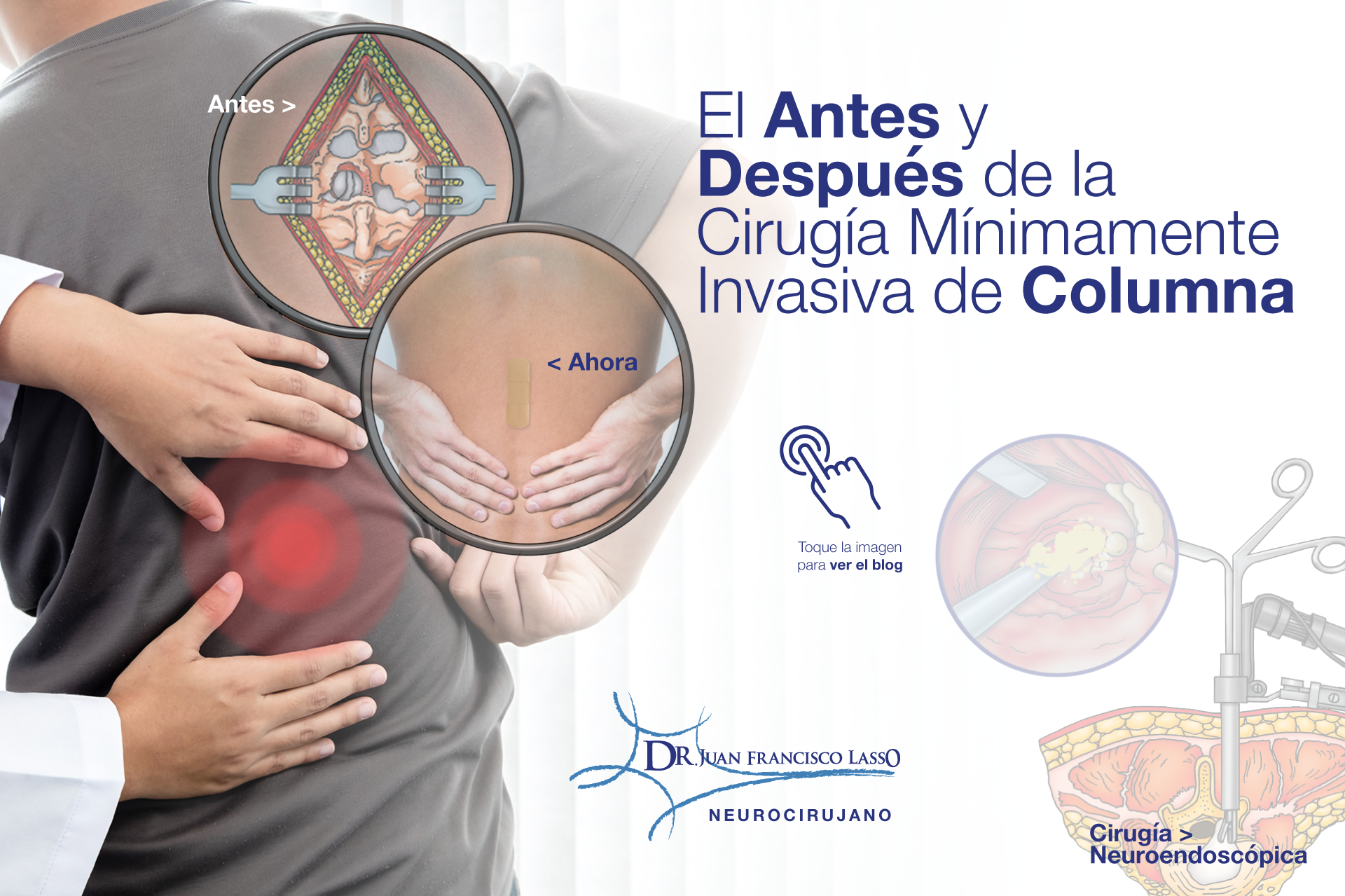 El antes y después de la cirugía mínimamente invasiva de columna